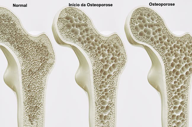 Epidemologia-da-Osteoporose